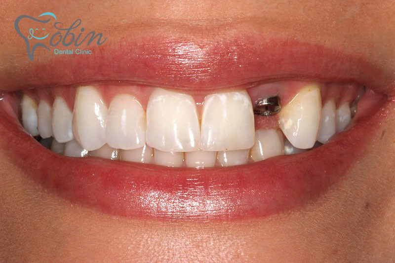ایمپلنت دندان یک روزه معمولا برای دندان های قدامی
